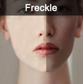 freckle freckle